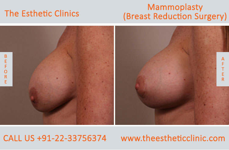Mammoplasty, Breast Reduction Surgery before after photos in mumbai india (4)